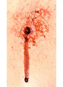 Bullet Entry/Exit  Prosthetic