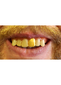 Teeth Glow Gold Miner