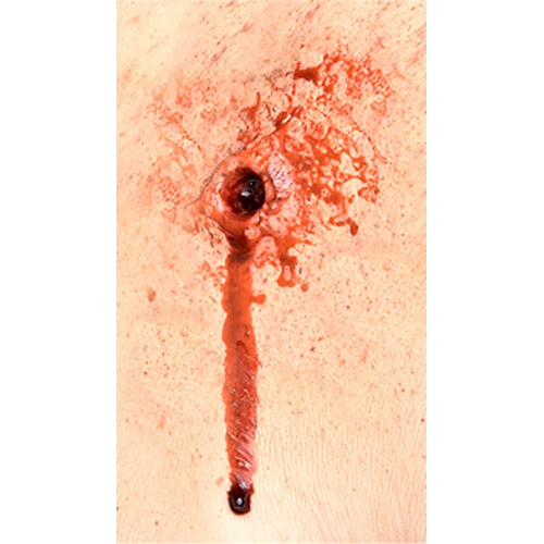 Bullet Entry/Exit  Prosthetic