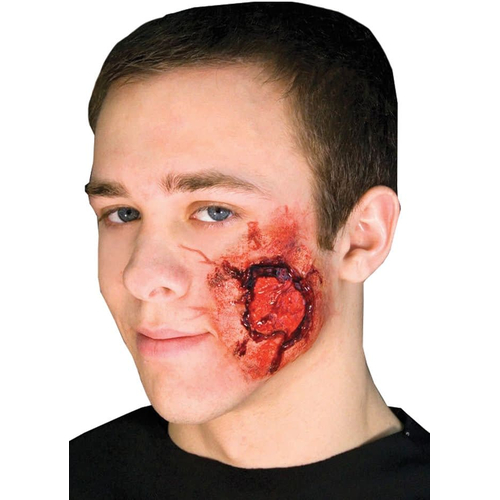 Open Wound